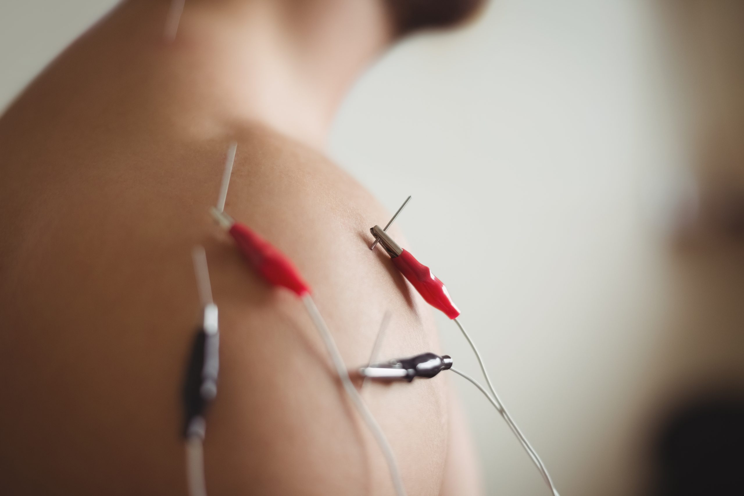 Close-up of patient getting electro dry needling on shoulder